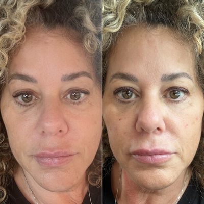 Filler (cheeks) - before and after