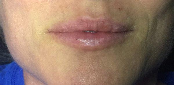 Natural lip augmentation