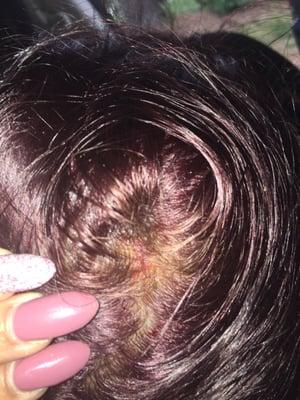 My burned scalp