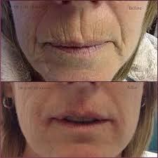 HIFU Ultrasound Therapy!  Lip lift