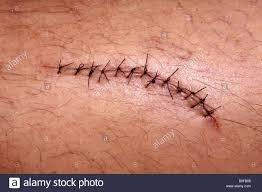 Laceration repair with sutures (stitches)