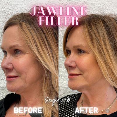 Juvederm Voluma Cheek and Juvederm Volux Jawline Filler