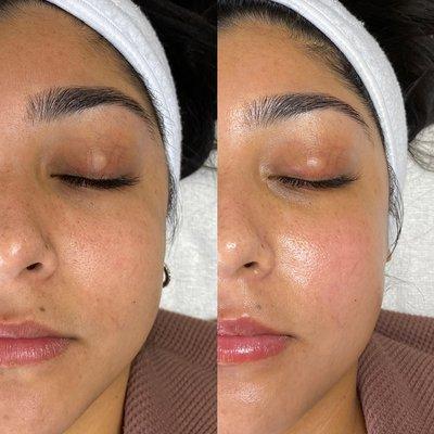 dermaplane facial. before (left) & after (right). instantly softer skin that is visibly smoother! recommended every 4 weeks.