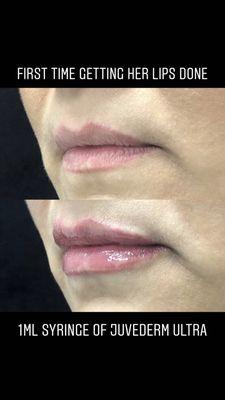 Lip enhancement