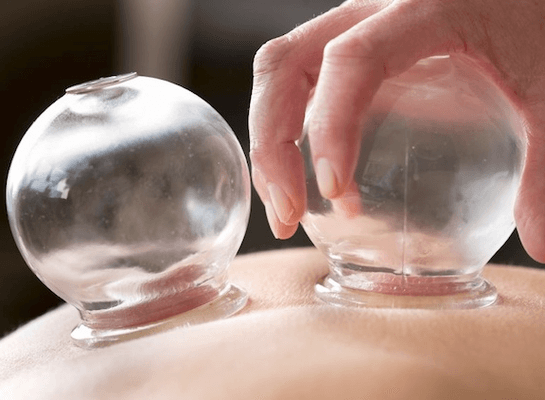 Cupping Therapy