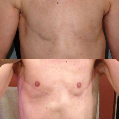 Before and 4 weeks healed after areola repigmentation