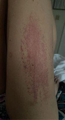 Rash from medications