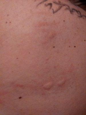 They sprayed 9-17-18 for bedbugs this is what I woke up with on my back on 9-19-18