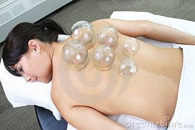 Cupping for sore back