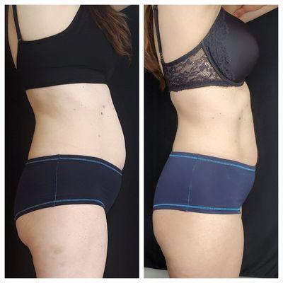 CoolSculpting and Emsculpt 90 days after.