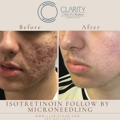 Acne Scarring treatment