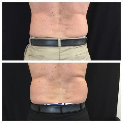 Coolsculpting Before and After