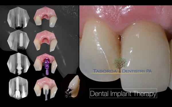 Dental Implants & Porcelain Crowns