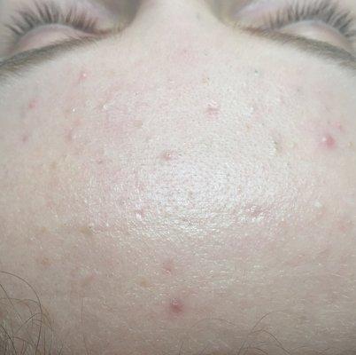 post acne treatment forehead, 3 facials /w extractions & at home products