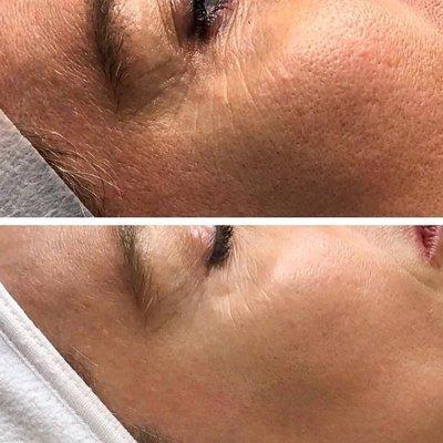 Texture difference after one Classic GREEN PEEL® Herbal Treatment!