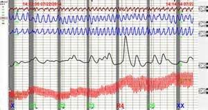 Polygraph Tracings