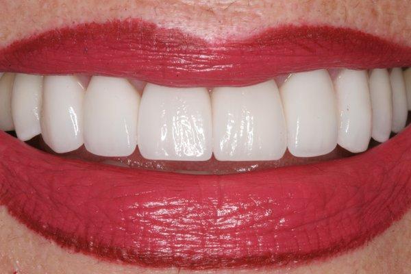 Patient FB loves her 'hollywood white' smile! I love the lifelike translucency and anatomy in these beautiful crowns!