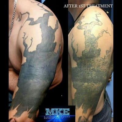 Milwaukee Laser Tattoo Removal