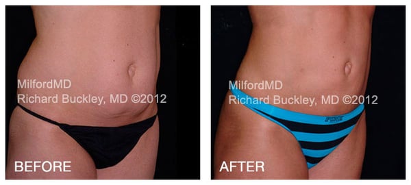 Before and After High Definition Bodysculpting - MilfordMD