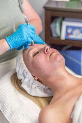 Microdermabrasion is a chemical free exfoliation for your skin giving you an instant result