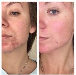 Amazing results with our Acne Package customized to each individual's needs.