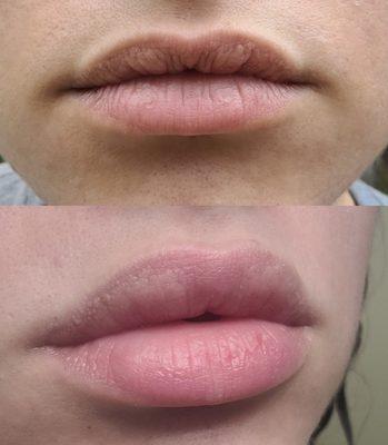 Gorgeous lips! Very natural result.