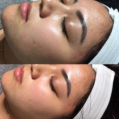 Before and after chemical peel. Instantly brightens face up