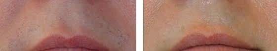 Laser Hair Removal - Before & After