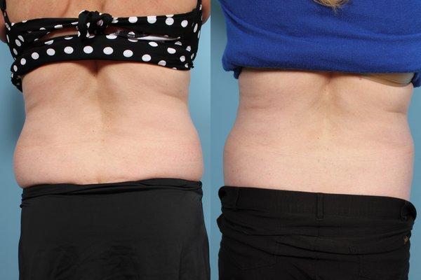 Body Contouring with Venus Legacy, 8 treatments