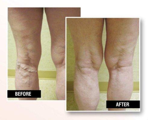 Before and After Vein Treatment