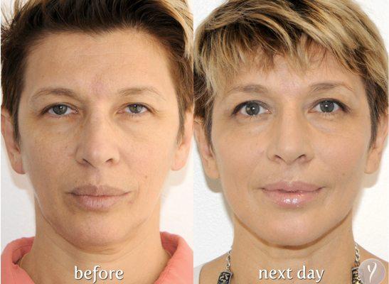 Nonsurgical Facelift by Nurse Nataly