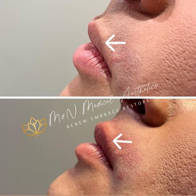 Dermal filler treatment to replace volume