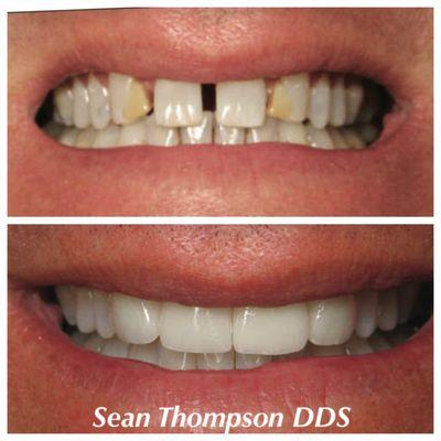 Restoring a confident smile