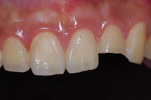 Fractured Lateral Incisor in an accident