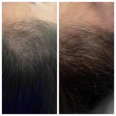 Before and after HydraFacial-Keravive hair treatment