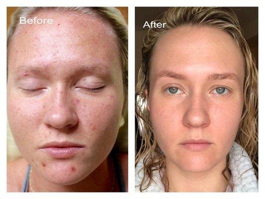 Virtual Acne Clearing Program