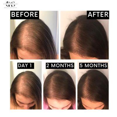 PRP for hair loss