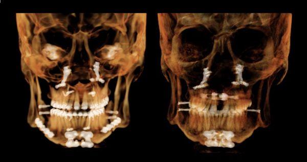 Before / after EASE: much wider nasal air passages