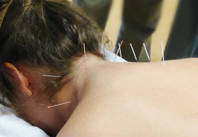 Trigger Point Dry Needling (Bio-Medical Acupuncture) for diagnosis and treatment of muscle pain.