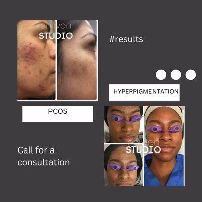 PCOS. Post acne scarring (blemish) treatment series.