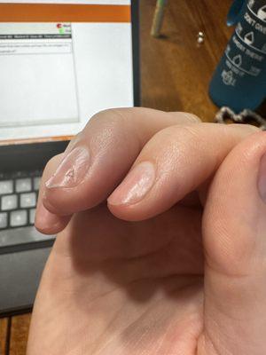 3 weeks after nail damage