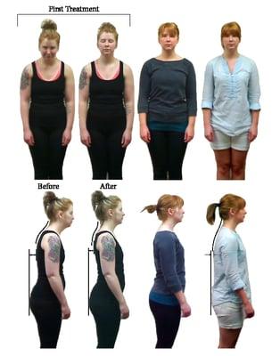 Huge postural changes and her lower back pain went away. Her testimonial is on our website.