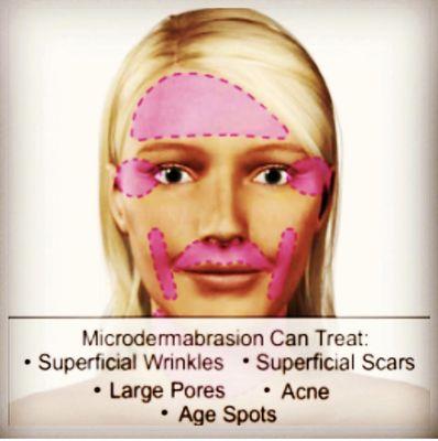 Microdermabrasion $60 for 1 session or buy 2 for $100 and we will throw in 2 free masks.