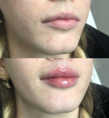 Before and after lip filler enhancement