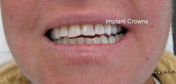 Two implants with crowns fill the space nicely.