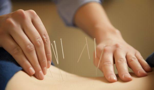 Acupuncture & Cupping  treatments