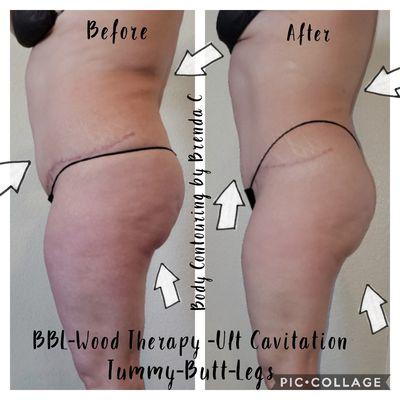 After 3 months post op care I did a Body sculpting BBL Cupping vacuum,Wood Therapy and Ultrasound Cavitation