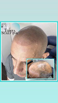 Thinning hair ? Scalp Micropigmentation can bring back your youth . Cut it low and make it look thicker at the same time .