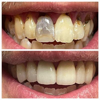 Cosmetic crowns used to enhance our patients smile.