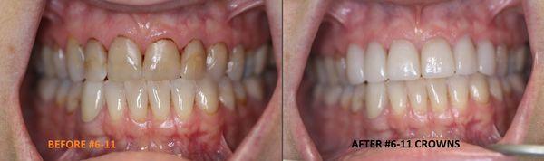 Before & After Cosmetic Crowns by Dr. Lee